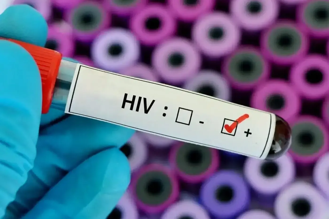 Governo do Amapá intensifica ações de prevenção e cuidado no enfrentamento ao HIV/Aids
