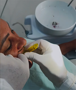 Vitória do Jari realiza moldagem para confecção de próteses dentárias